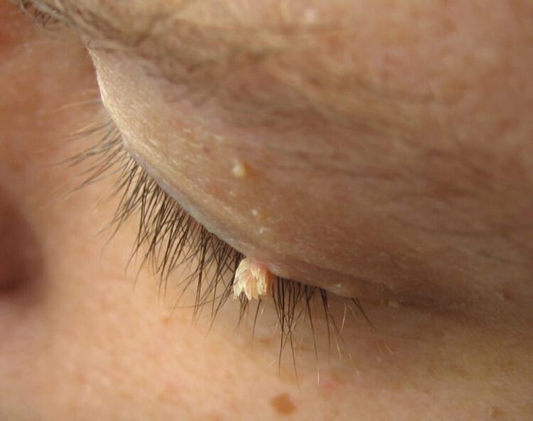 papilloma on the eyelids