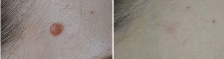photos before and after laser papilloma removal 2