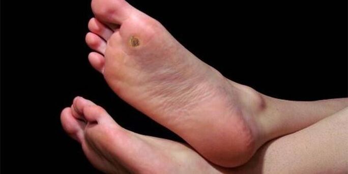 Plantar warts (spikes) on the legs
