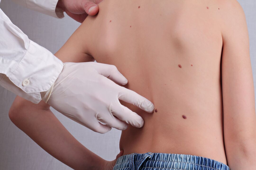 Dermatologists conduct clinical examinations of patients with papillomas on the body