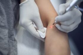 Laser treatment