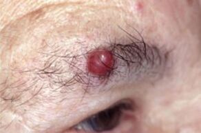 Papilloma on the eyebrows