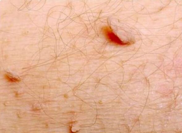 Sharp papilloma in the human body