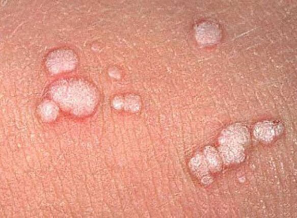 papillomas in the human body