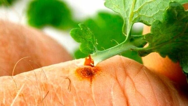 Applying Celandine Juice to Warts