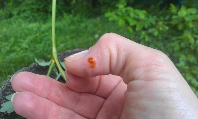 Celandine is used for fingers