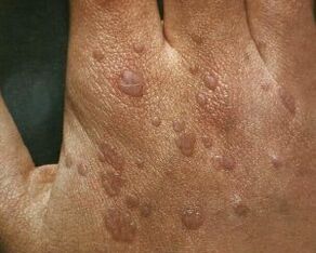 cause of warts