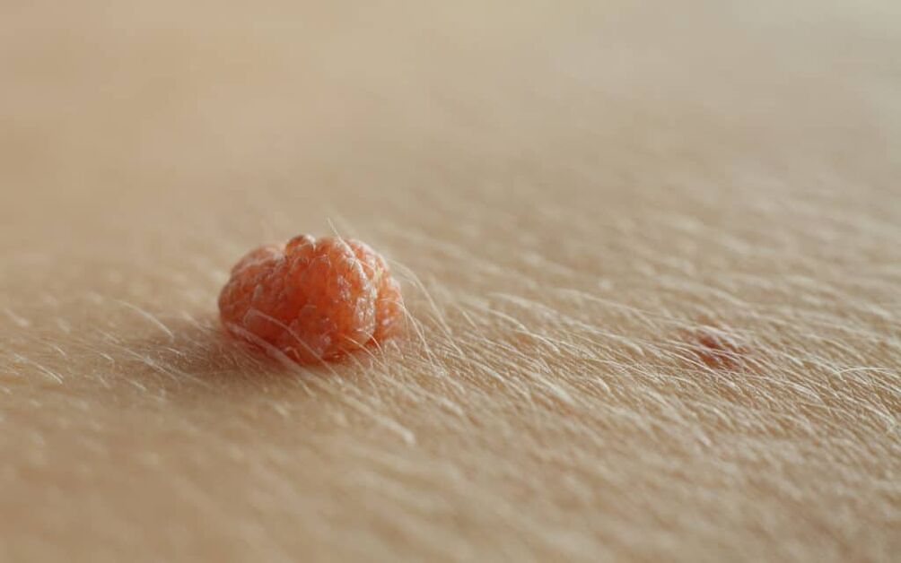 Papilloma