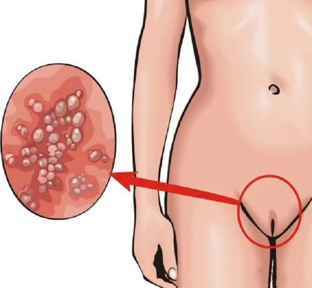 papilloma in the perineum