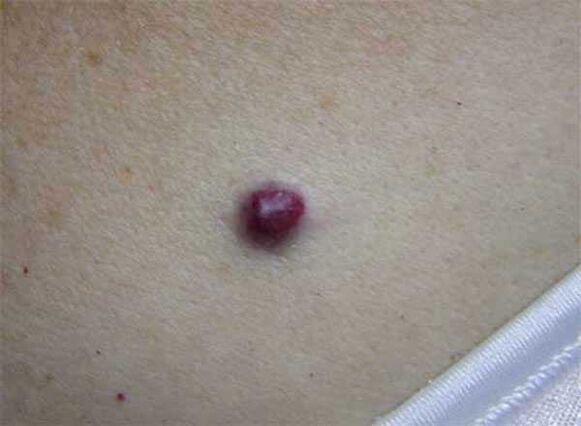 red moles on the body