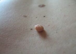 A papilloma is a growth on the surface of the skin