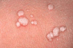 Flat papilloma