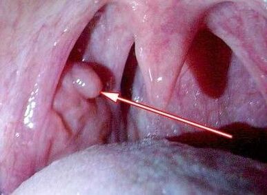 Papilloma in the throat