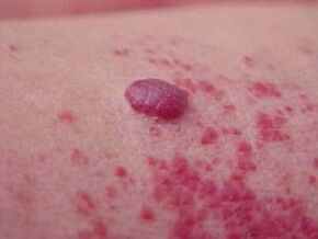 Red spots around the papilloma