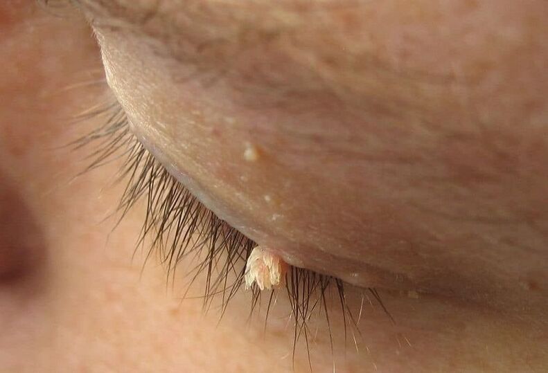 filamentous warts on the eyelids