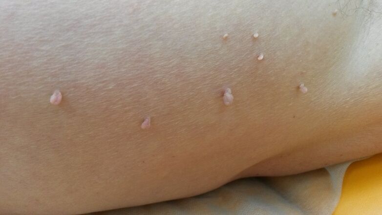 papilloma on the human body