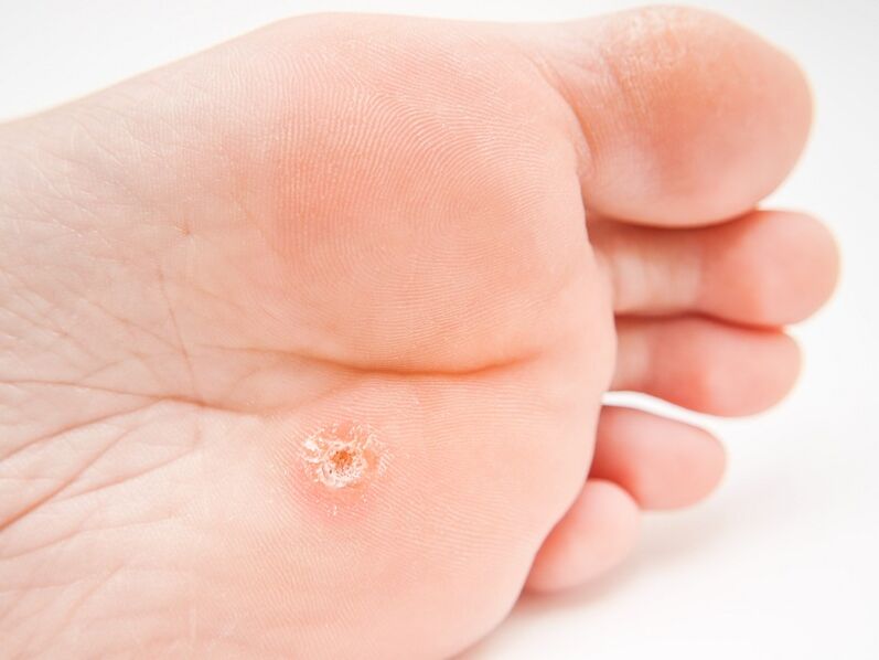 plantar warts on the feet