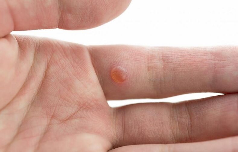 rough warts on fingers