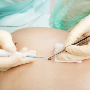 papilloma removal by a surgeon