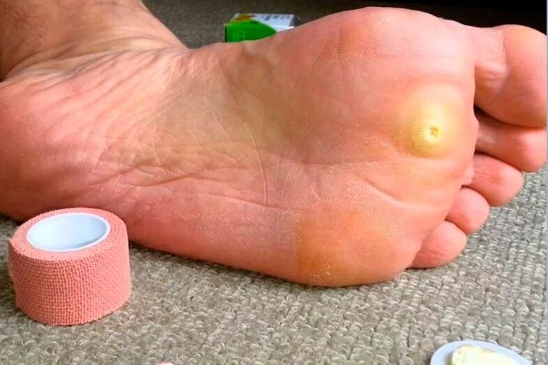 plantar warts on the feet