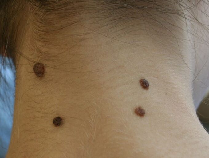 What does a papilloma look like on the neck