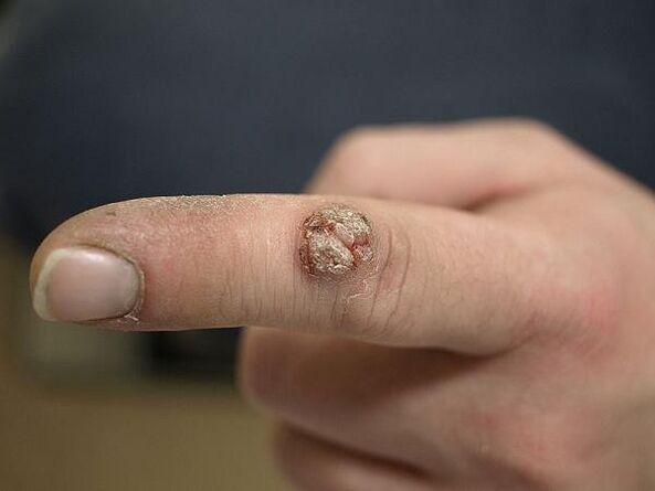 Papilloma on the finger