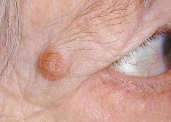 papilloma on the eyelids