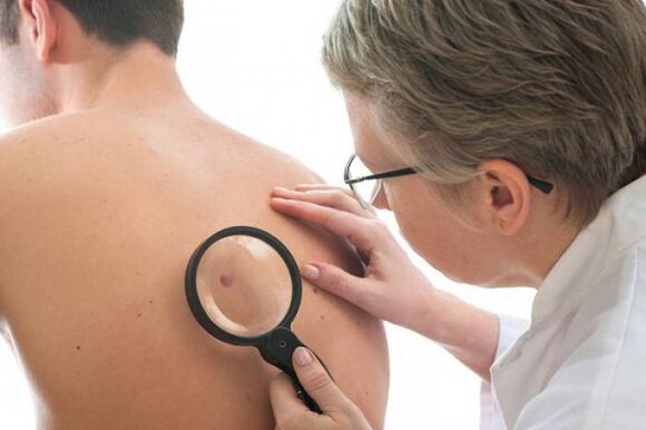 the doctor examines the papilloma on the back