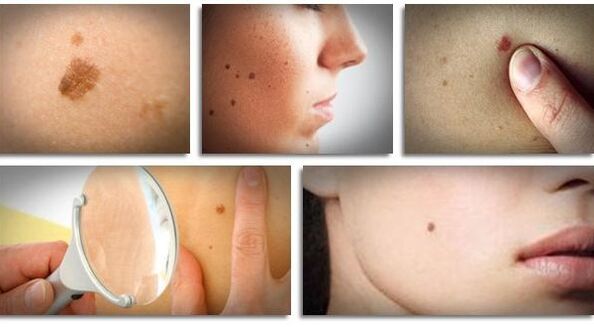 type of papilloma virus on the body