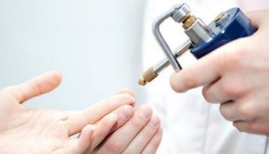 Cryodestruction as a method of treating warts