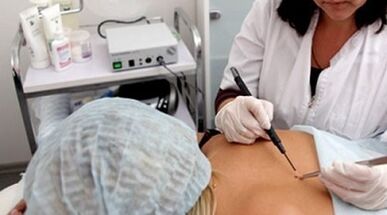 Electrokoagulation as a method of removing warts