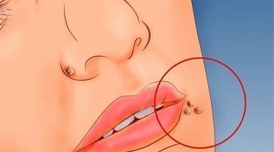 Reason -because the appearance of warts