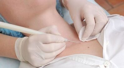 Removal of laser warts